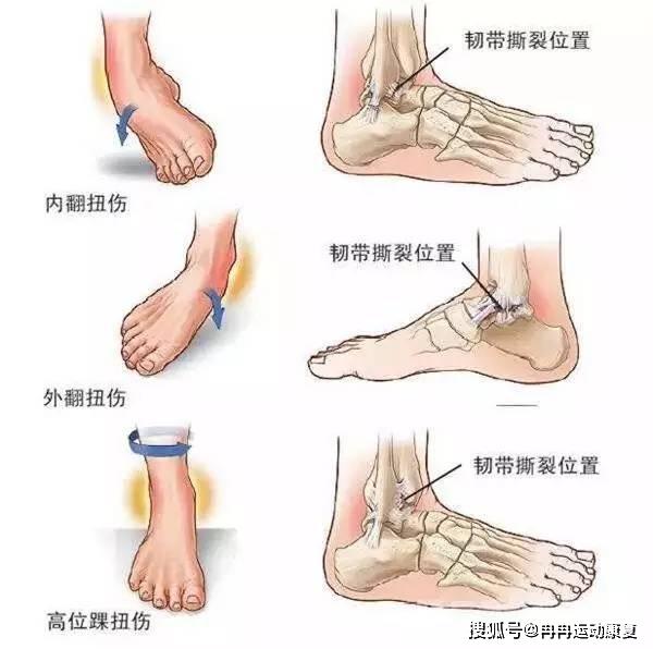 脚踝扭伤几个月还痛，原因、治疗与康复